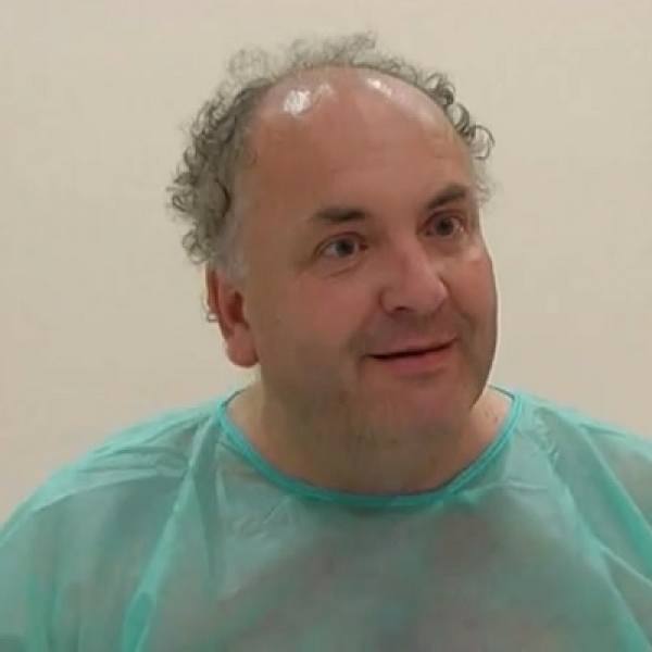 Ralph Blumson Before Hair Transplant